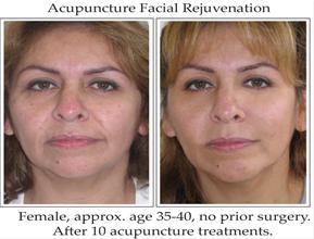 Acupuncture Facial Rejuvination